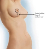 Why Opt for Breast Lift Surgery in Mumbai? Explore the Benefits & Expert Insights