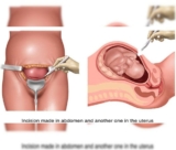 Dr. Arohi Tasgaonkar: The Leading C Section Delivery Doctor in Thane