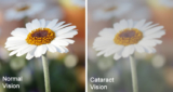 How Much Does Cataract Surgery Cost in Mumbai?
