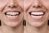 Dental Veneers in Hyderabad: The Ultimate Solution for a Perfect Smile
