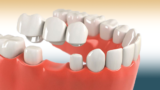 Dental Crowns and Bridges: Types, Work, Cost