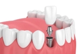 The Impact of Dental Implants on Quality of Life