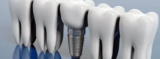 Comparing Dental Implants and Bridges: Which Is Best?