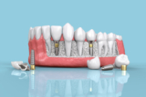 Finding the Right Dental Implant Specialist in Adajan