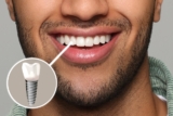 Dental Implants for Smokers: Risks and Recommendations