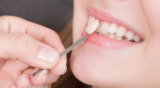 The Best Oral Hygiene Practices for Veneer Wearers