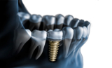 The Impact of Dental Implants on Oral Health in Islamabad