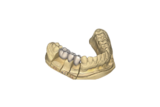 The Role of Digital Scanning in Crown and Bridge Procedures