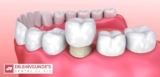 Dental Crown in Solapur — Expert Treatment by Trusted Cosmetic Dentists
