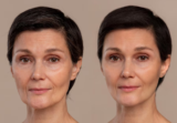 Botox vs. Thread Lift: Which Anti-Aging Treatment is Right for You?