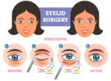 Eyelid Surgery in Navi Mumbai: Enhance Your Appearance with Precision