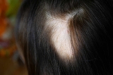 What is Finasteride and how does it work for hair loss?