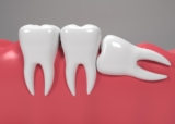 Wisdom Tooth Removal Cost in Dubai: A Comprehensive Guide