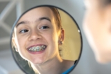 A Comprehensive Guide to Dental Braces: Types, Benefits, and Considerations