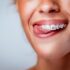 Clear Aligners: A Modern Approach to Straightening Teeth