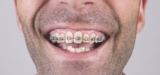 The Ultimate Guide to Dental Braces