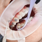 Orthodontics in Dubai – Achieve a Perfectly Aligned Smile