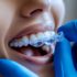 The Ultimate Guide to Dental Implants: Everything You Need to Know