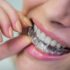 The Comprehensive Guide to Dental Implants