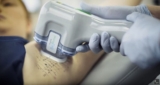 Does MiraDry Treatment Provide Sweat Reduction?