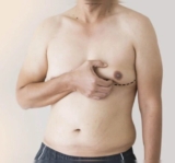 Dr. Sanket Ekhande: Best Gynecomastia Surgeon in Navi Mumbai