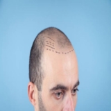 PRP Therapy for Hair Transplants in Riyadh: Enhancing Your Results