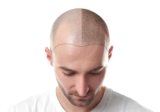 The Psychological Benefits of Hair Transplant Surgery