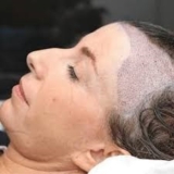 The Ultimate Guide to Hair Transplant Procedures in Riyadh