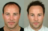 A Comprehensive Guide to Post-Operative Care After Hair Transplant in Dubai