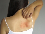 Seasonal Hives: Causes and Best Treatment in Islamabad