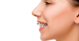 How Braces Can Correct Overbite Issues