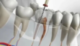 How Long Does a Root Canal Last? Durability, Aftercare, and Expert Tips