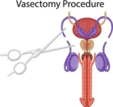 Vasectomy: What You Need to Know Before the Procedure