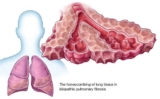 Lung Fibrosis Doctor in Mumbai: Expert Care for Effective Treatment