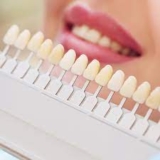 Long-lasting Dental Veneers: Essential Aftercare Strategies