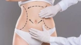 Liposuction Myths vs. Facts: Debunking Common Misconceptions