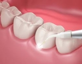Get Rid of Wisdom Tooth Woes: Premier Removal Services in Hornsby by Whitecross Dental