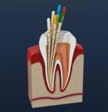 Diet Recommendations After Single-Sitting Root Canal Therapy