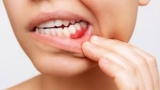 Preventing Gum Disease After Tooth Extraction