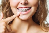 How Braces Can Close Diastema (Gap Between Teeth)