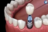 Dental Implants for People with Diabetes: What to Know