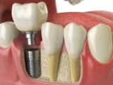 Understanding the Recovery Process for Dental Implants