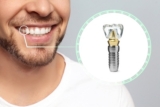 How Dental Implants Can Supercharge Your Smile