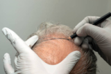 Top Reasons to Choose the Best Hair Transplant in Jaipur for a New You