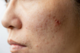 Acne Treatment in Abu Dhabi: Your Clear Skin Solution