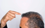 Hair replacement clinic in Delhi- The non-surgical process to get rid of hair fall
