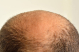 Hair Transplant in Abu Dhabi: High Quality and Affordable Solutions