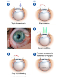 Discover Clear Vision with LASIK Eye Surgery in Ghatkopar