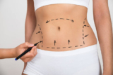 Liposuction Surgery in Dubai: Safe and Effective