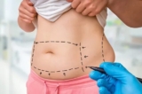 5 Tips for a Successful Liposuction Surgery in Dubai